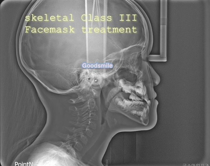 Phase one treatment of skeletal Class III, dental …