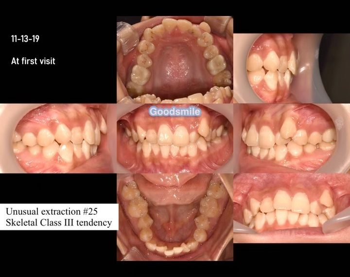 Unusual extraction of skeletal Class III, dental C…