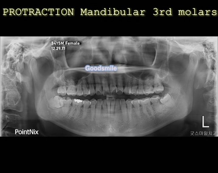 Challenging case protraction of both impacted man…