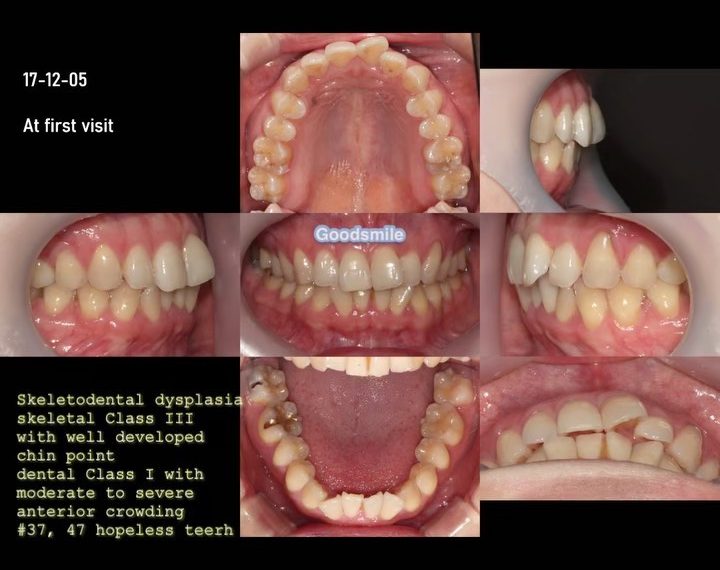 Protraction of both impacted mandibular 3rd molars…