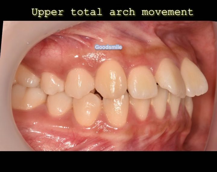 Changes of six months treatment When you decide e…