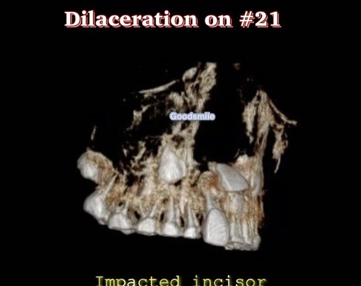 Orthodontic traction of impacted upper incisor wit…