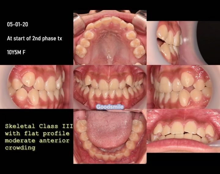 Treatment of skeletal Class III with anterior mode…