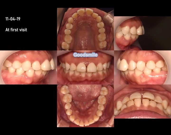 Treatment of dental Class I with lip protrusion an…