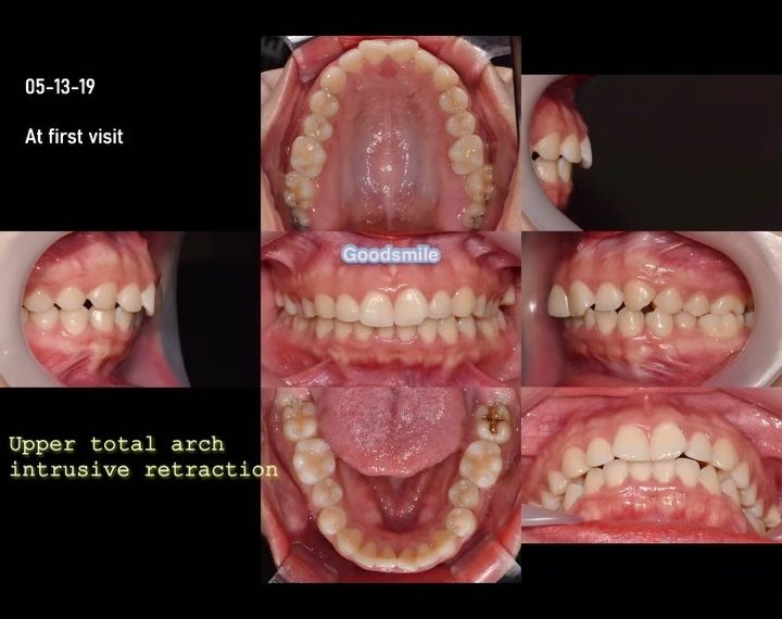 Treatment of skeletal Class I, dental Class II, di…