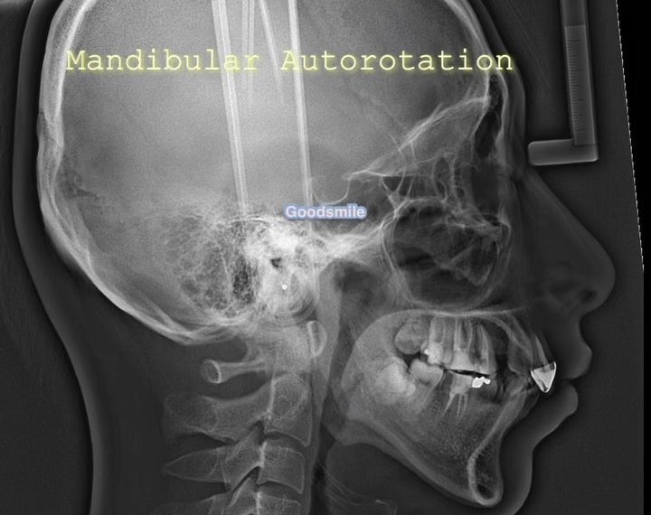 Mandibular autorotation in hyperdivergent patient …