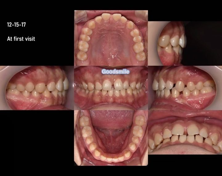 Space closure with maintaining inclination of ante…