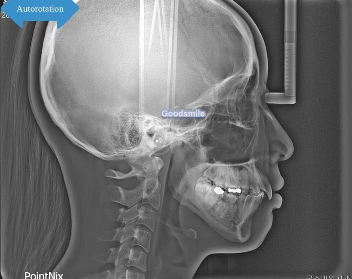 Mandibular autorotation after upper total arch int…