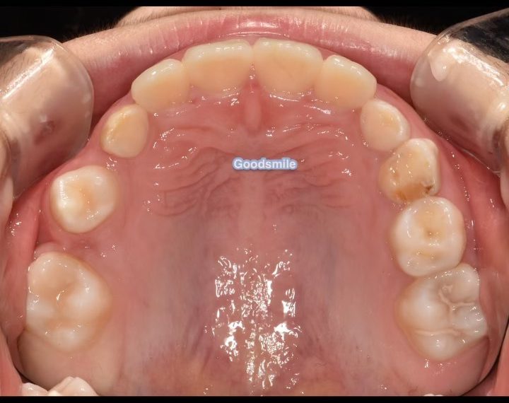 Space regaining of upper right 2nd premolar due to…