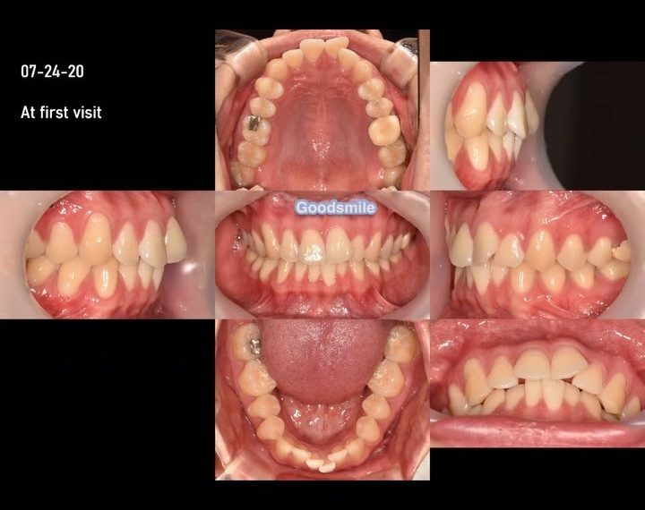 Nonextraction treatment of moderate anterior crowd…