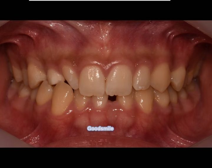 Treatment of palatal impacted #13 between #12 & #1…