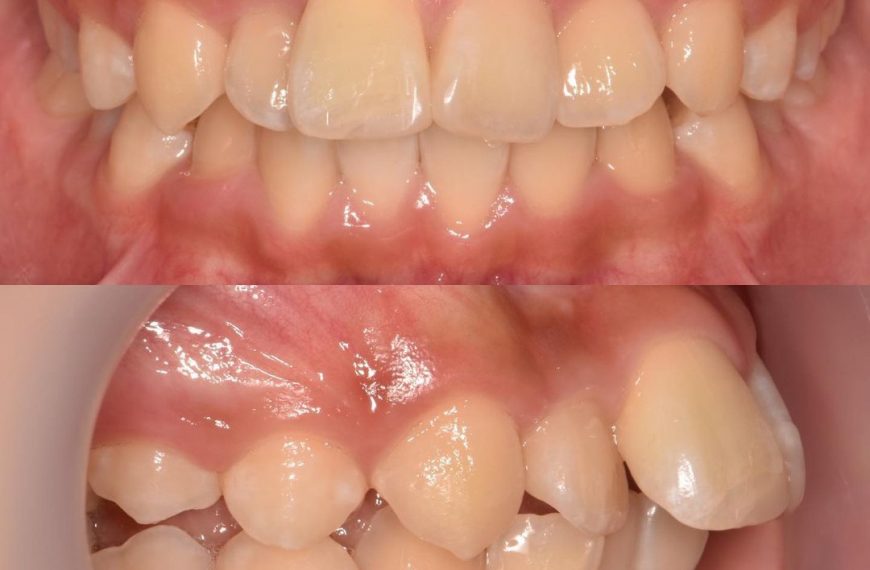 upper right central incisor was ankylosed due to a…