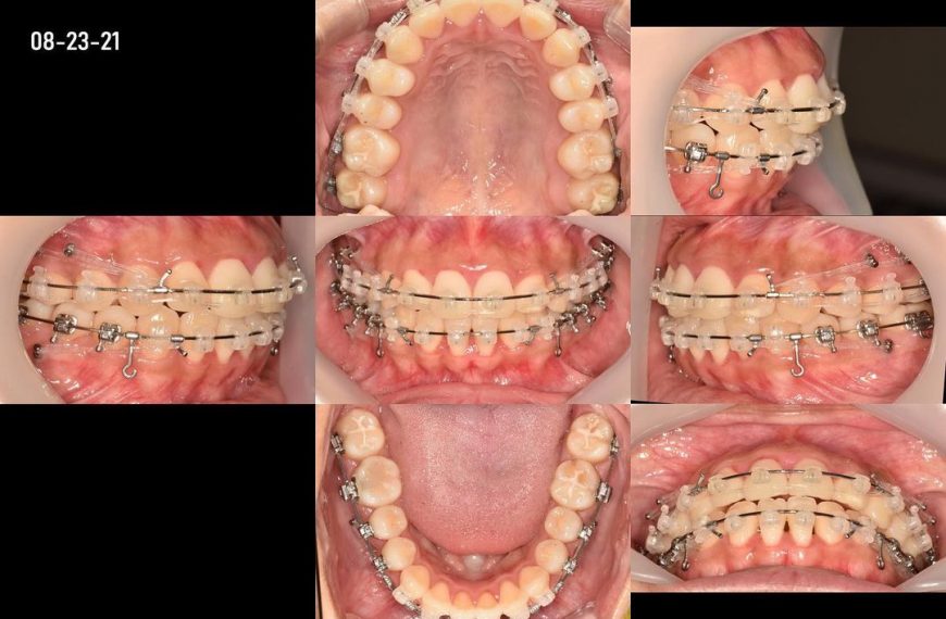 double arch retraction 4 microimplants on upper …