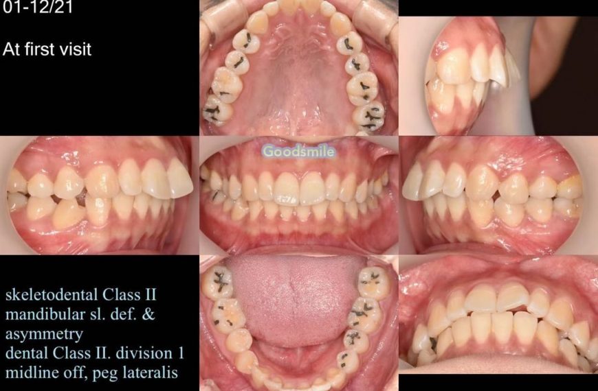 Treatment of dental Class II, division 1 with micr…