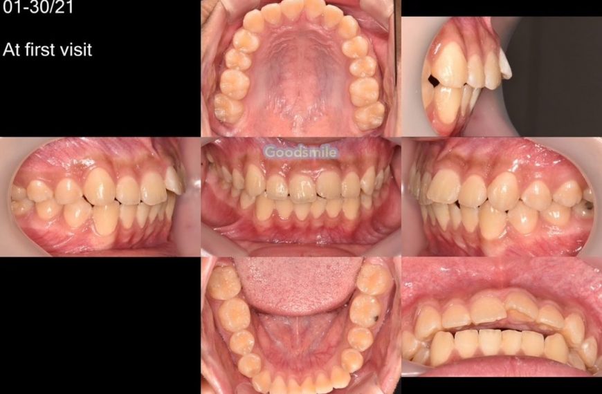 Treatment of dental Class II with anterior crowdin…