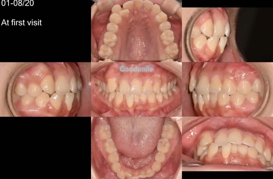 Treatment of dental Class II with anterior crowdin…