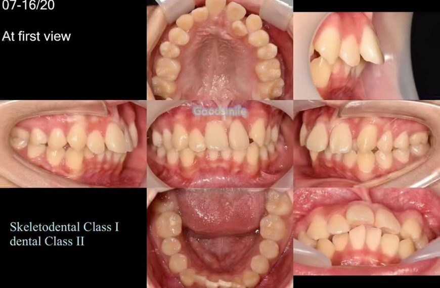 Treatment of dental Class II 1. DBS .018” MBT 2. …