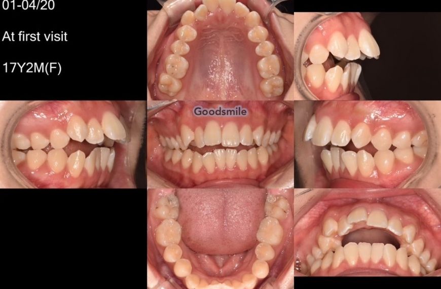 Camouflage treatment of skeletal Class II with ope…