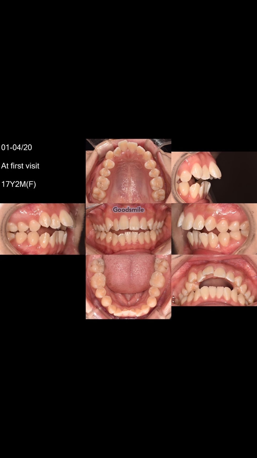 Camouflage treatment of skeletal Class II, mandibu - 굿스마일포럼