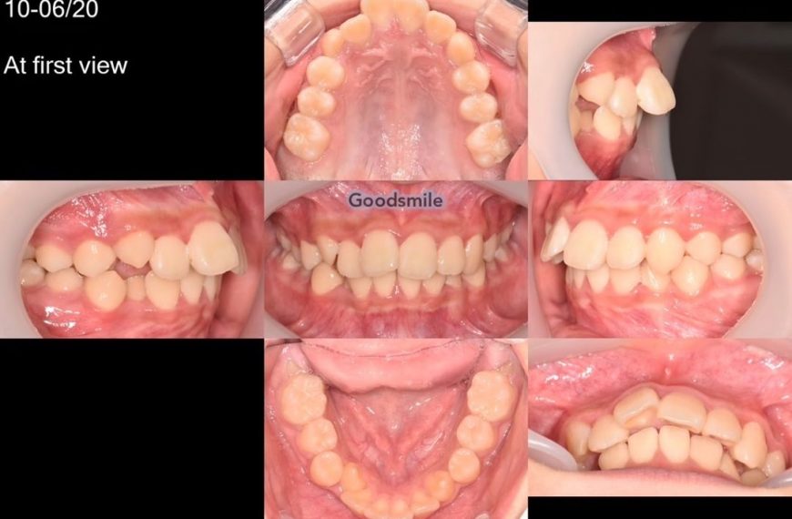 Treatment of skeletodental dysplasia, skeletal Cla…