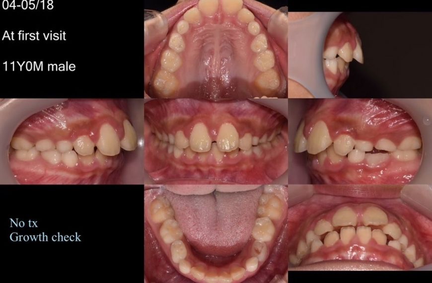 Treatment of skeletal Class II, mandibular deficie…