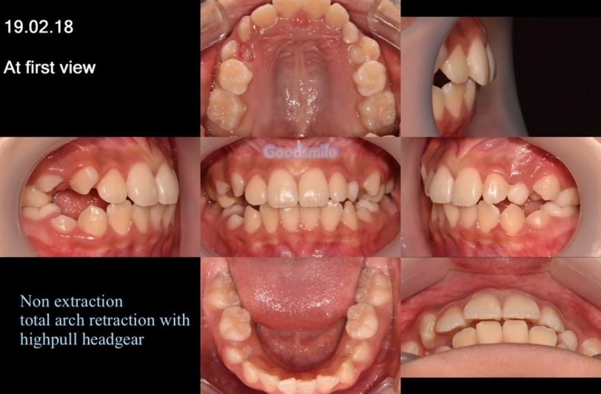 Treatment of dental Class II with highpull headgea…