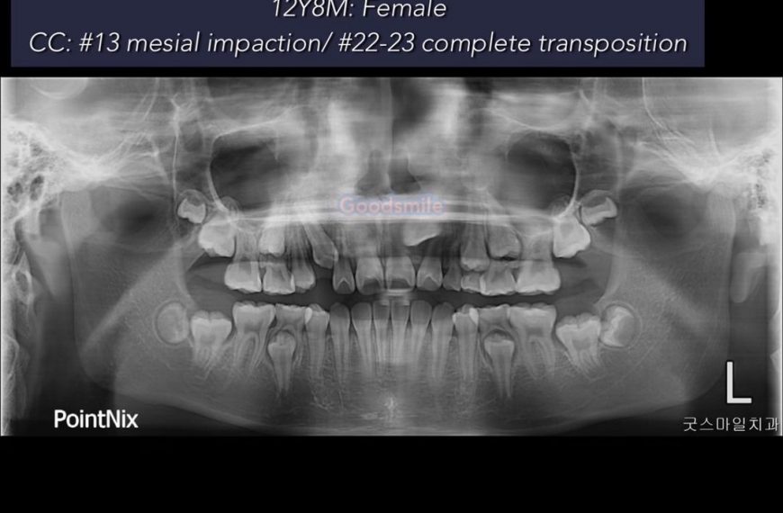 Treatment of complete transposition case, skeletod…