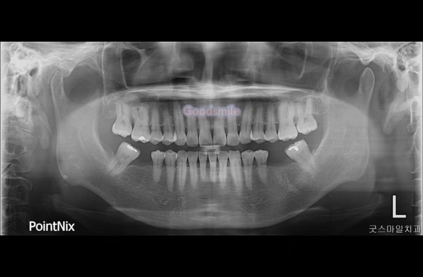 Uprighting of both mandibular 2nd molars with limi…