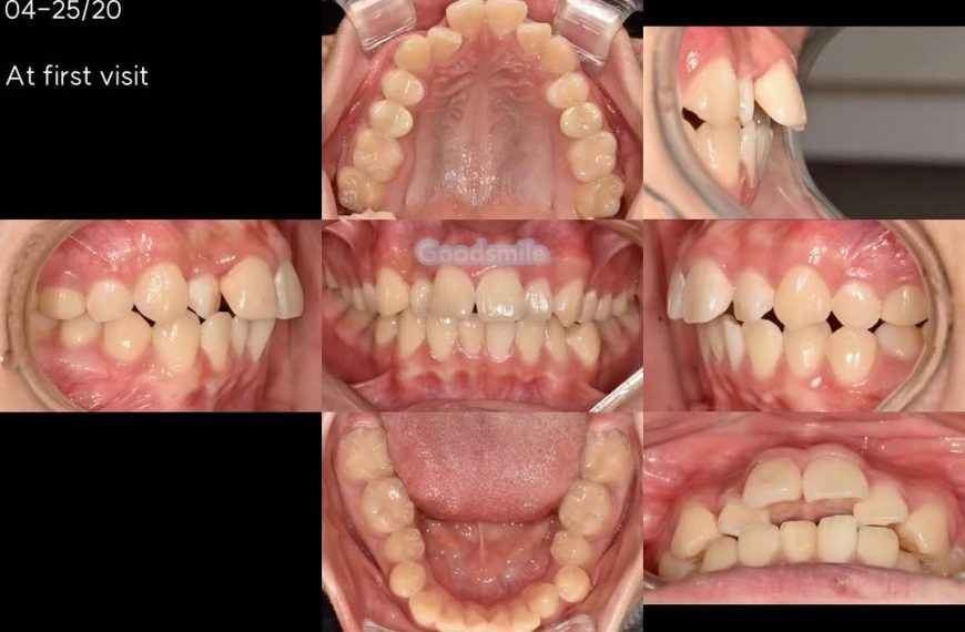 Treatment of skeletal Class II, dental Class II 1…