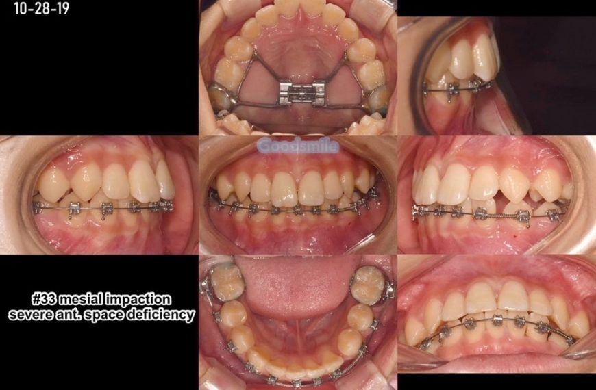 Treatment of impacted lower canine without extract…