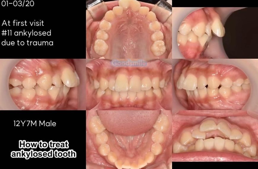 Treatment of skeletodental Class II malocclusion w…