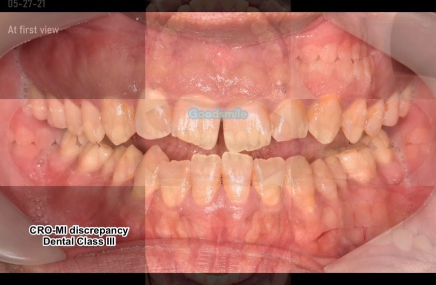 Camouflage treatment of skeletodental Class III wi…