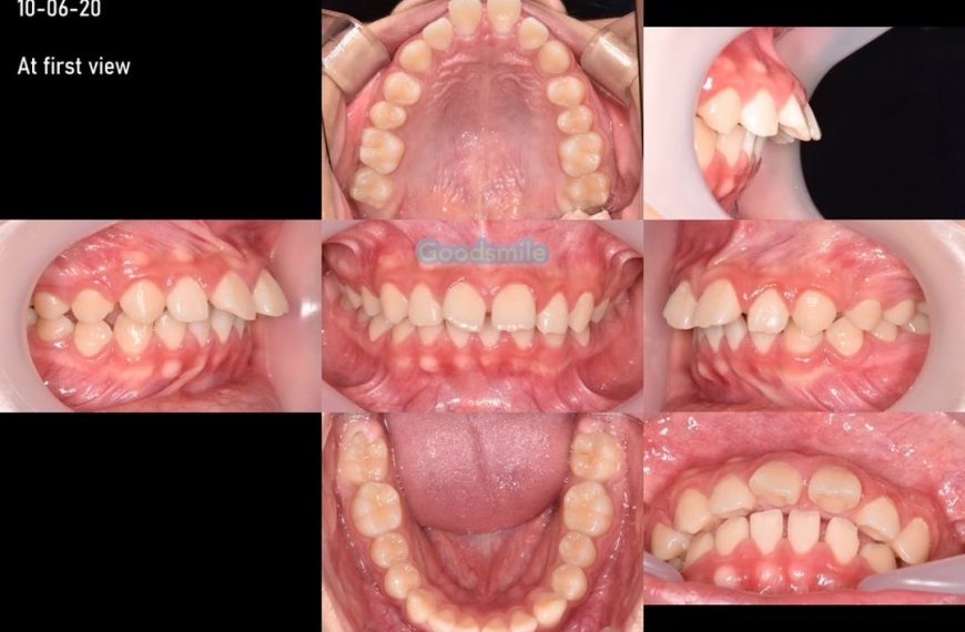 Camouflage treatment of skeletal Class II, dental …