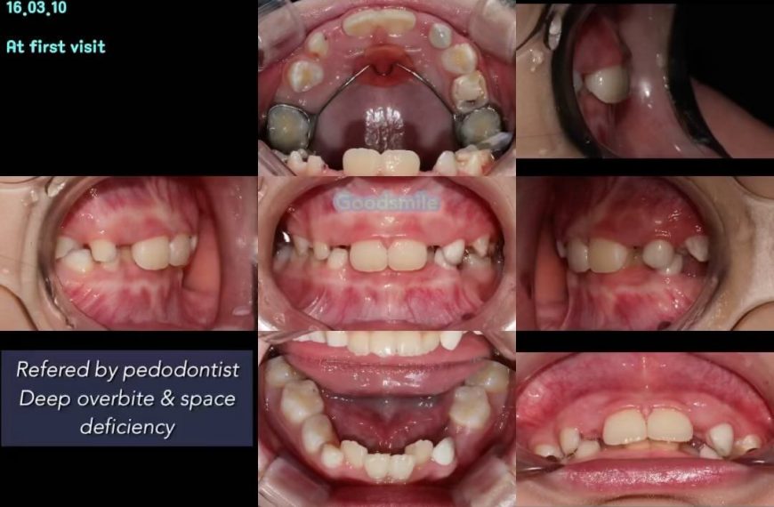 Treatment of skeletodental Class II, dental Class …