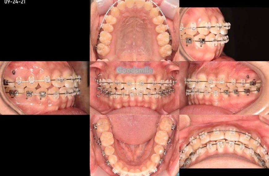 Camouflage treatment of skeletodental Class III ma…