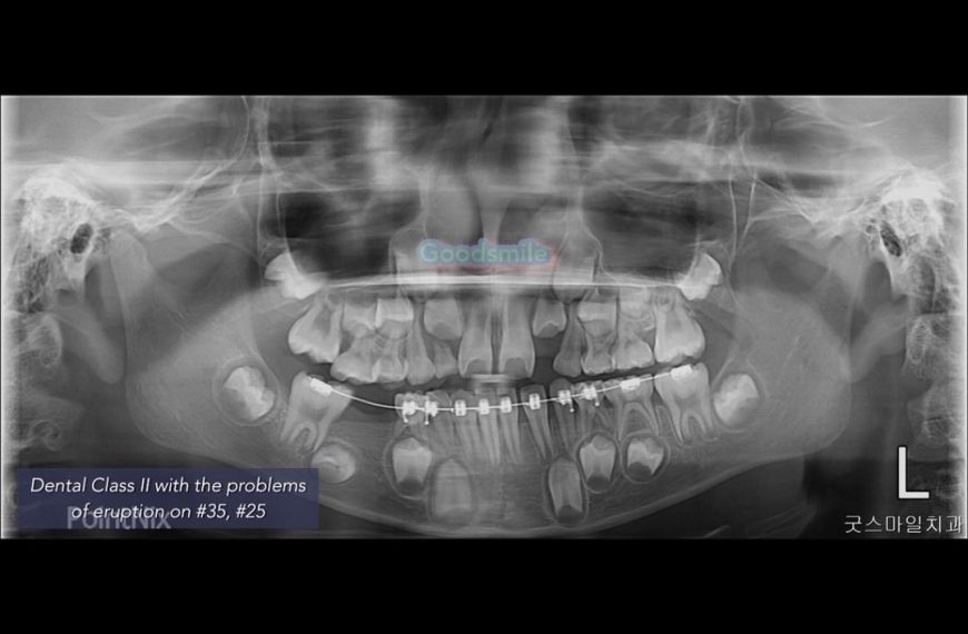 Early treatment of dental Class II with severe eru…