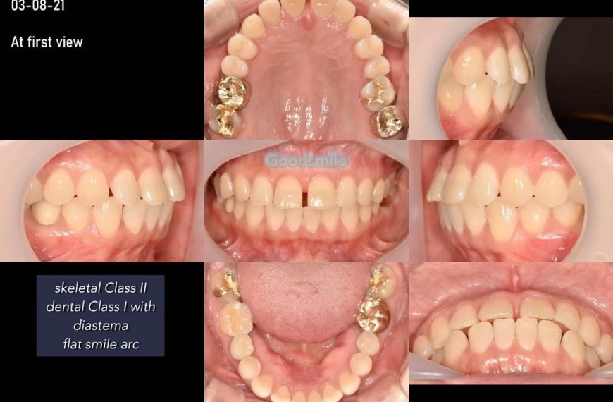 treatment of dental Class I with spacing based on …