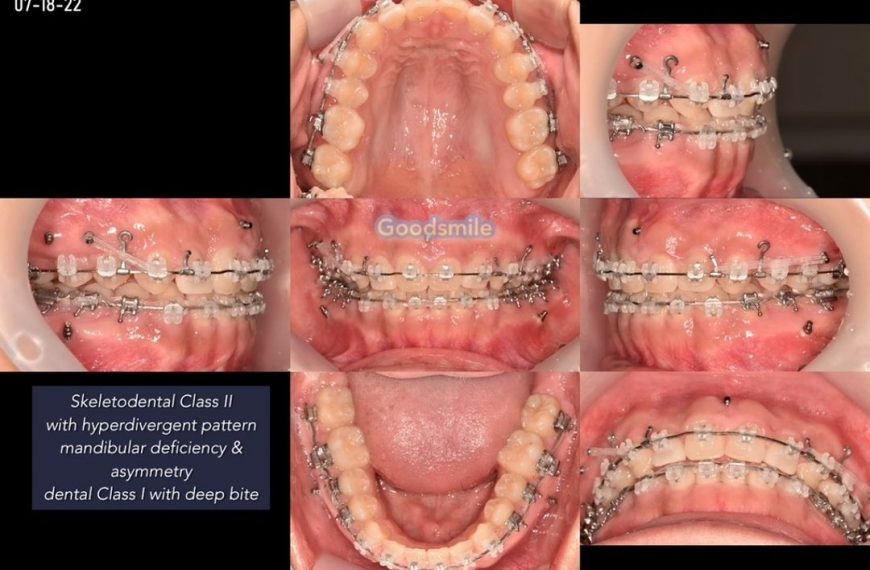 Non surgical treatment of skeletodental Class II w…