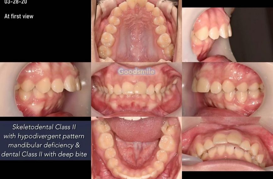 Non-extraction treatment of skeletodental dysplasi…