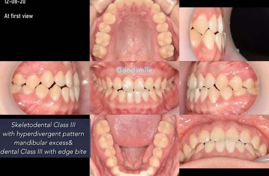 Nonsurgical treatment of skeletodental dysplasia, …