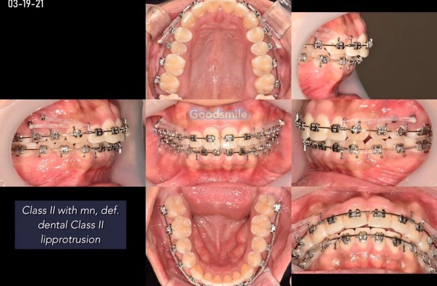 Treatment of skeletodental Class II with lipprotru…