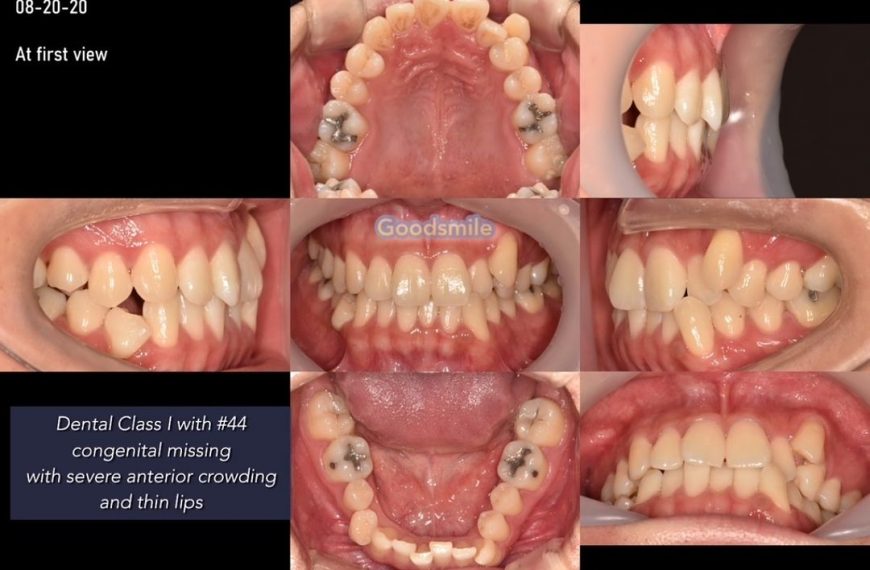 Treatment of dental Class I with anterior severe c…