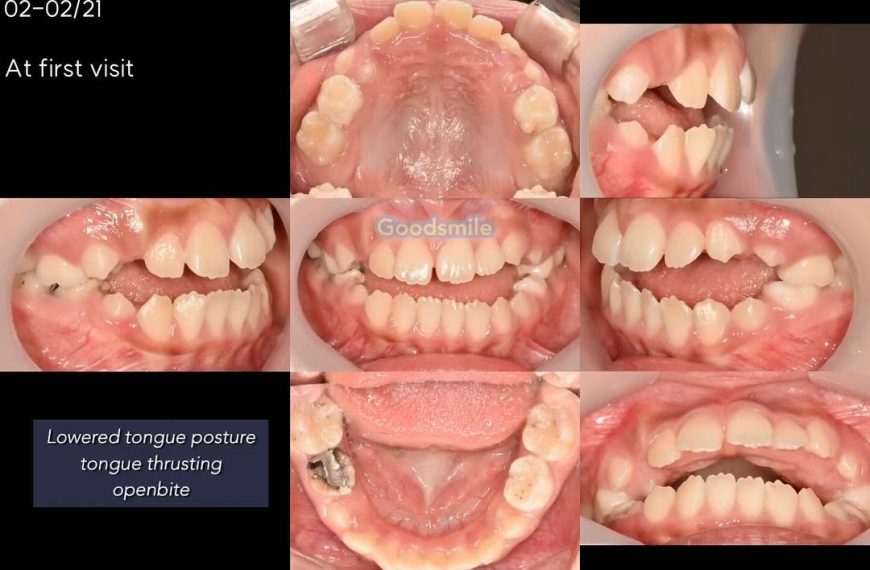 Shut down -open bite due to lowered tongue posture…