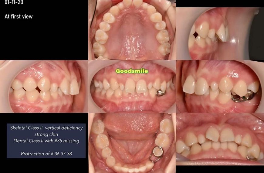 Unilateral molar protraction to correct congenital…