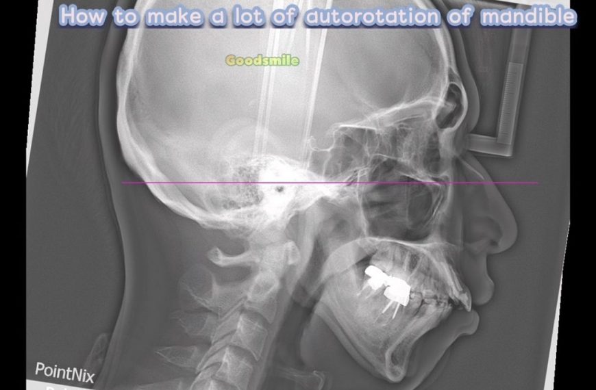 How to make significant mandibular autorotation in…