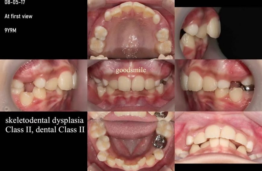 Treatment of skeletal Class II, mandibular deficie…