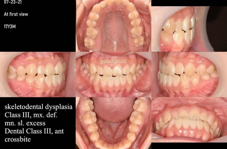 Camouflage treatment of skeletodental Class III, d…