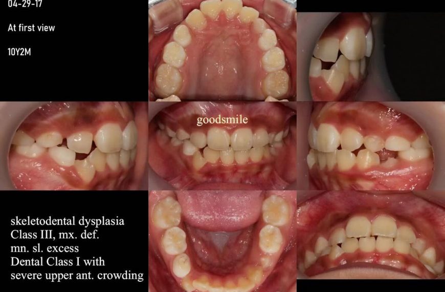 2-phase treatment of skeletodental Class III, dent…