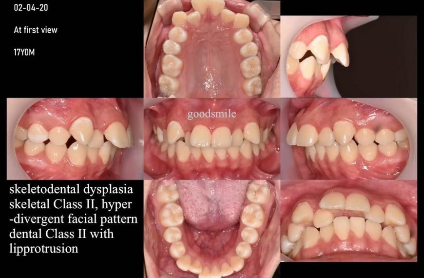 Camouflage treatment of skeletal Class II, hyperdi…