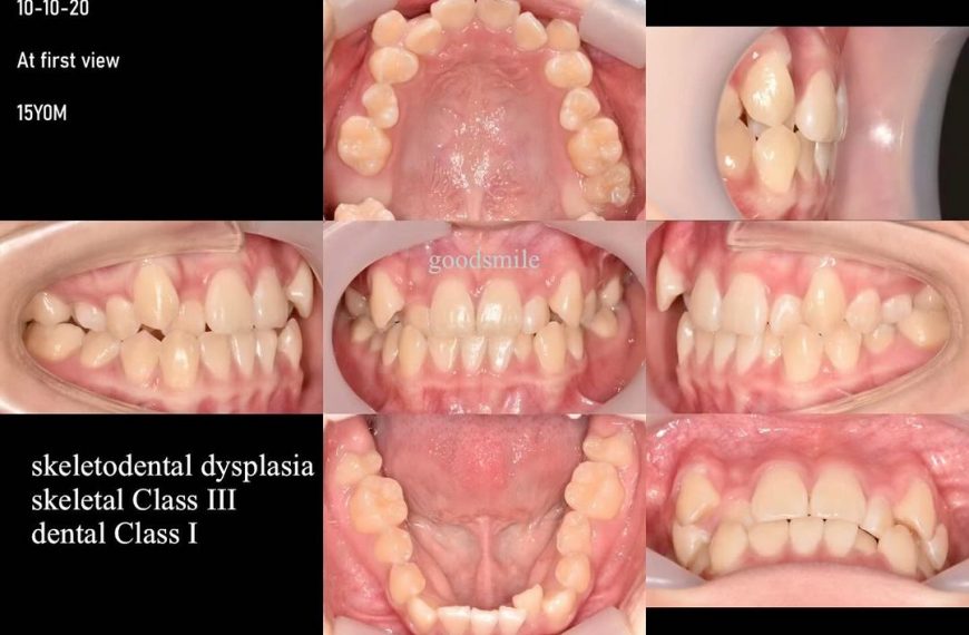 Camouflage treatment of skeletal Class III, dental…